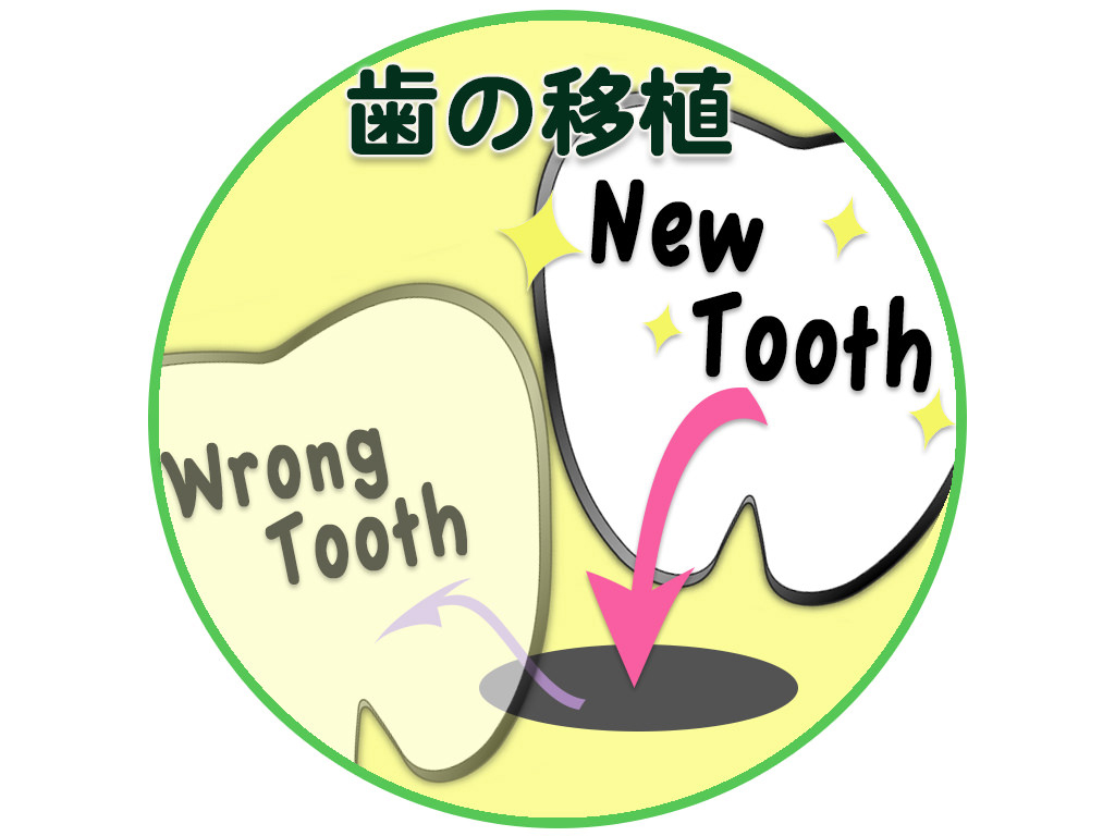 「歯の移植」という選択肢